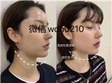 少女線是什么？艾美緹（艾美緹ST筋膜再植）可以打造出少女線嗎？