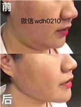 面部下垂無光澤，做線雕管用嗎