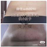 艾美緹只能做臉嗎/NO，艾美緹還可以做肚子，副乳
