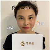 做完艾美緹后感覺一下年輕了十歲！這個效果真的讓我太驚喜了